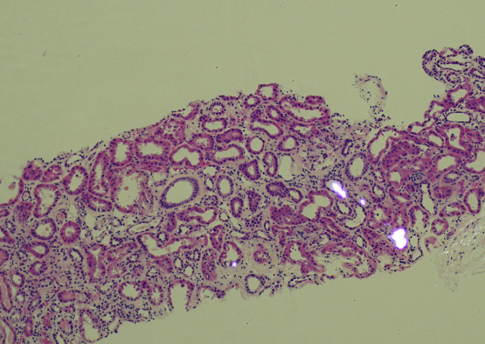 Calcium oxalate crystals accumulated in kidney tubules under polarizing lightA photomicrograph of the kidney biopsy from a 64-year-old woman with diabetes mellitus (DM) associated with acute kidney injury (AKI) due to acute oxalate nephropathy (AON). The light microscopy combines polarized light microscopy to show that some dilated renal tubules contain polygonal calcium oxalate crystals. Hematoxylin and eosin (H&E). Magnification ×20.