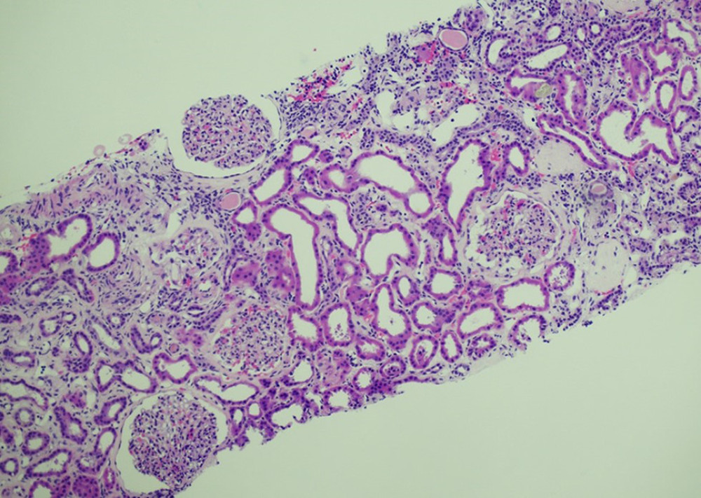 Diabetic nephrosclerosis and oxalate nephropathy leading to acute tubular injuryThe section shows characteristic changes of diabetic nephrosclerosis, including thickened glomerular basement membranes and nodular glomerulosclerosis. Additionally, calcium oxalate crystals are observed within the lumen of kidney tubules.