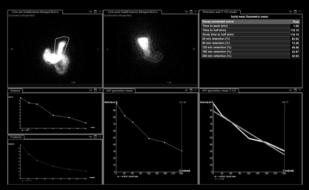 Gastric emptying scintigraphy, which is the criterion standard test for diagnosing gastric gastroenteropathyThe patient was diagnosed with gastroparesis, likely due to diabetes, after observing the 31% retention after 4 hours (normal value: less than 10% at 240 minutes), confirming delayed gastric emptying of a solid meal on the gastric emptying scintigraphy.