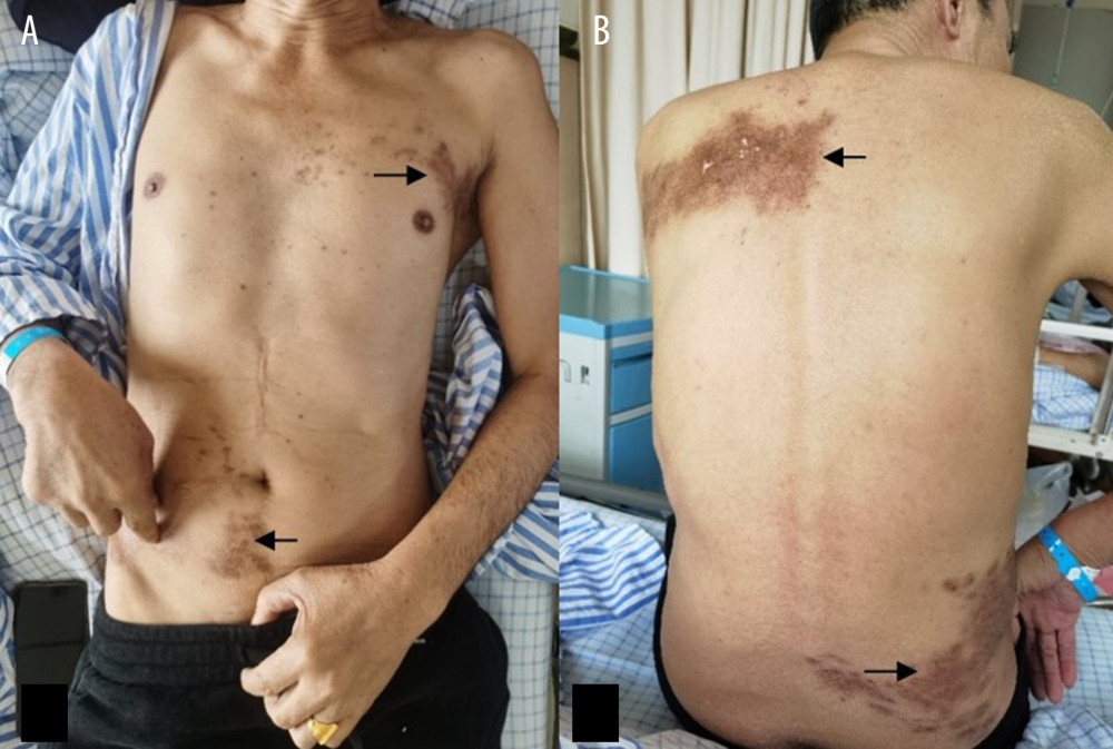 (A) The patient’s frontal view shows significant skin pigmentation (black arrow) in the left chest (T3 segment) and right abdomen (T11 segment). (B) The patient also had pigmentation on the skin of the same nerve segment on the back. The pain also came from the skin pigmentation areas shown in figures a and b above.