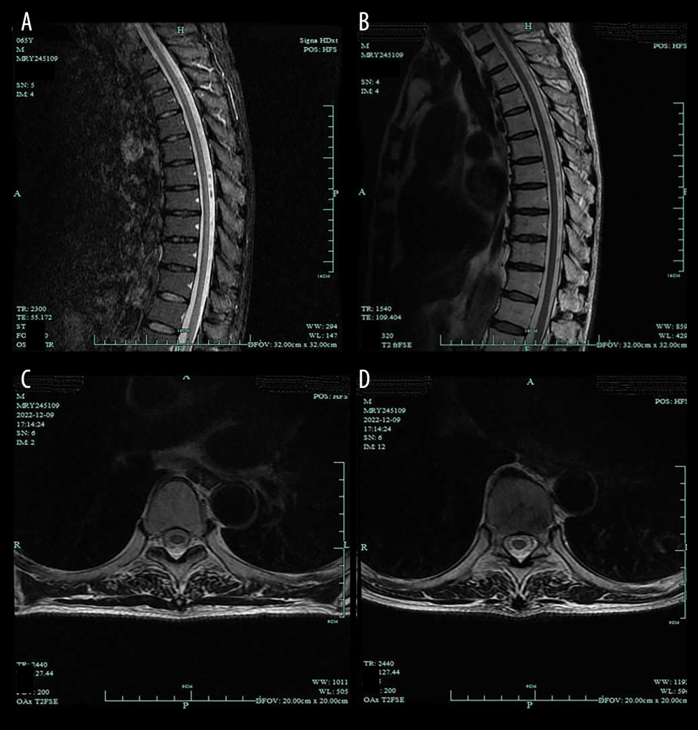 (A–D) The patient’s thoracic MRI showed no intraspinal- or extraspinal-related lesions, intervertebral disc herniation, spinal cord lesions, intraspinal tumors, or vertebral fractures.
