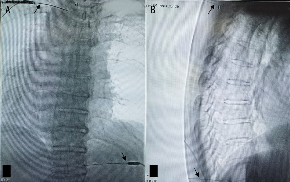 (A) In the prone position, digital subtraction angiography (DSA)-guided T3 and T11 nerve pulse radiofrequency anteroposterior films were taken, with the tip of the radiofrequency puncture needle (black arrow) located below the external pedicle of the vertebral arch. (B) DSA-guided T3 and T11 nerve pulse radiofrequency lateral films are shown, with the tip of the radiofrequency puncture needle located in the upper middle of the intervertebral foramen.