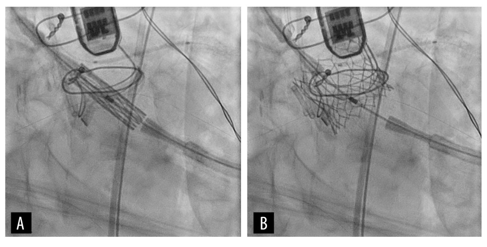Intraoperative fluoroscopic images of transcatheter aortic valve replacement (TAVR) deployment. (A) TAVR apparatus in position across the old bioprosthetic valve, and (B) showing successful deployment of the balloon-expandable valve prosthesis.