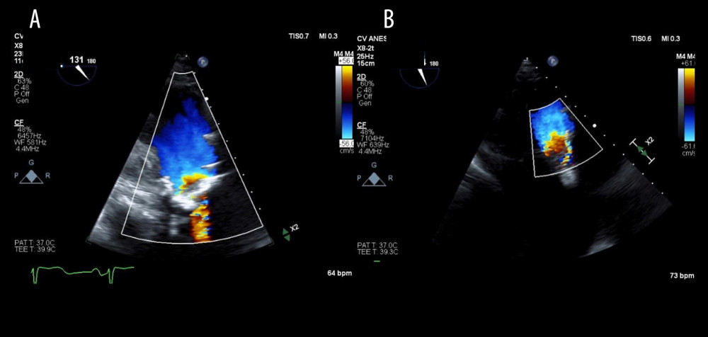 Intraoperative transesophageal echocardiogram Doppler images of aortic valve. (A) Preoperative image demonstrating the severity of aortic stenosis and high-velocity jet with turbulent flow before aortic valve, and (B) after valve deployment, which demonstrated trace paravalvular leak, no central jet, and uniform blood flow through an open aortic valve.