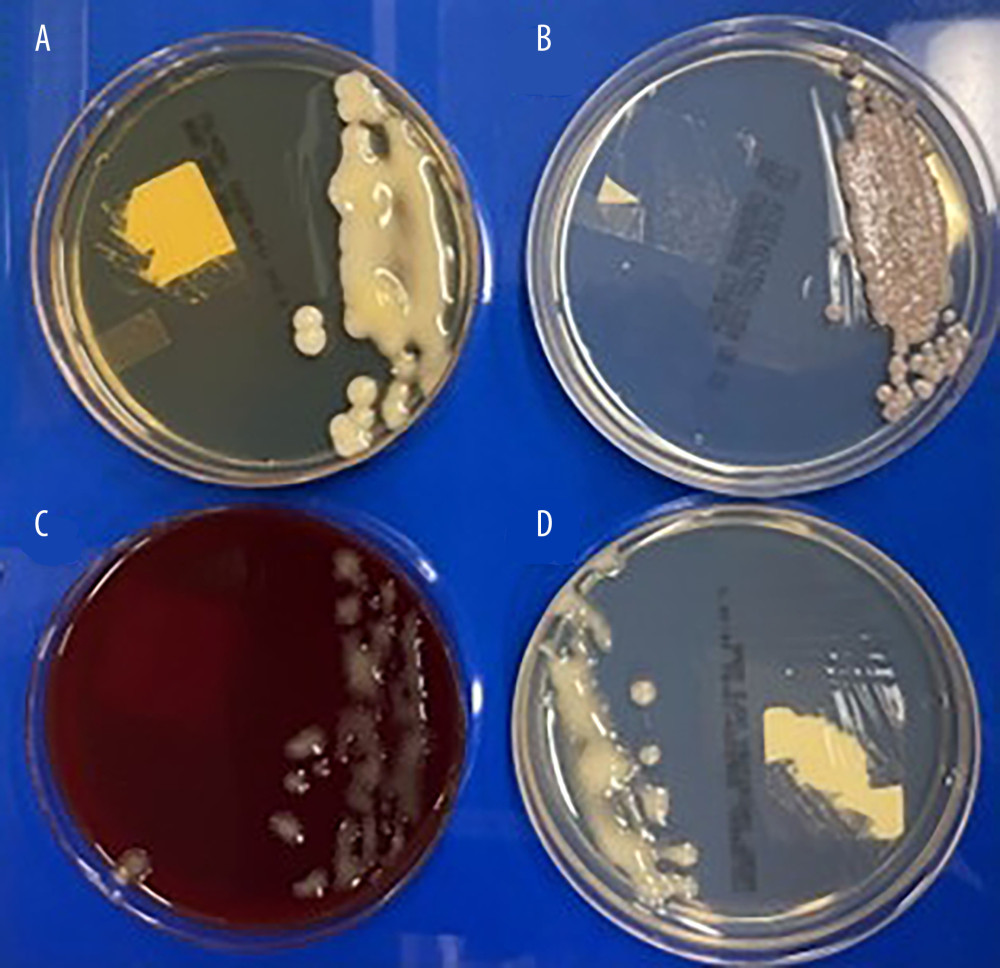 Culture of Cryptococcus neoformans on Sabouraud dextrose agar and blood agar platesThis figure shows mucoid, creamy, smooth colonies characteristic of Cryptococcus neoformans on Sabouraud dextrose agar (culture plates A, B, D]) and blood agar (culture plate C) media. These colony morphologies are indicative of fungal growth.