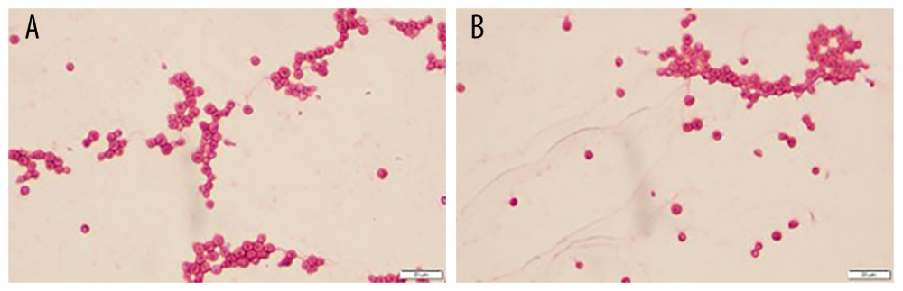 Gram stain of Cryptococcus neoformans from blood culture(A, B) These panels show Gram-stained images revealing narrow-based budding yeast forms consistent with Cryptococcus neoformans. The organisms appear as thin-walled, encapsulated yeast with varying sizes, seen in clusters.