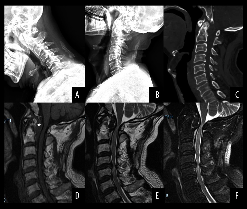 (A, B) Hyper flexion and extension radiographs showed no instability of C1–C2. (C) Sagittal reconstructive computed tomography scan of the cervical spine showed cervical degeneration and multiple cysts in the upper cervical spine. A subaxial cervical stenosis was diagnosed based on the Pavlov ratio in C3–C7. (D, E) A huge mass was noted posterior to the dens. The mass was hypointense on T1- and T2-weighted magnetic resonance imaging (MRI). (F) Only the rim of the pseudotumor was enhanced on T2-weighted contrast-enhanced MRI.
