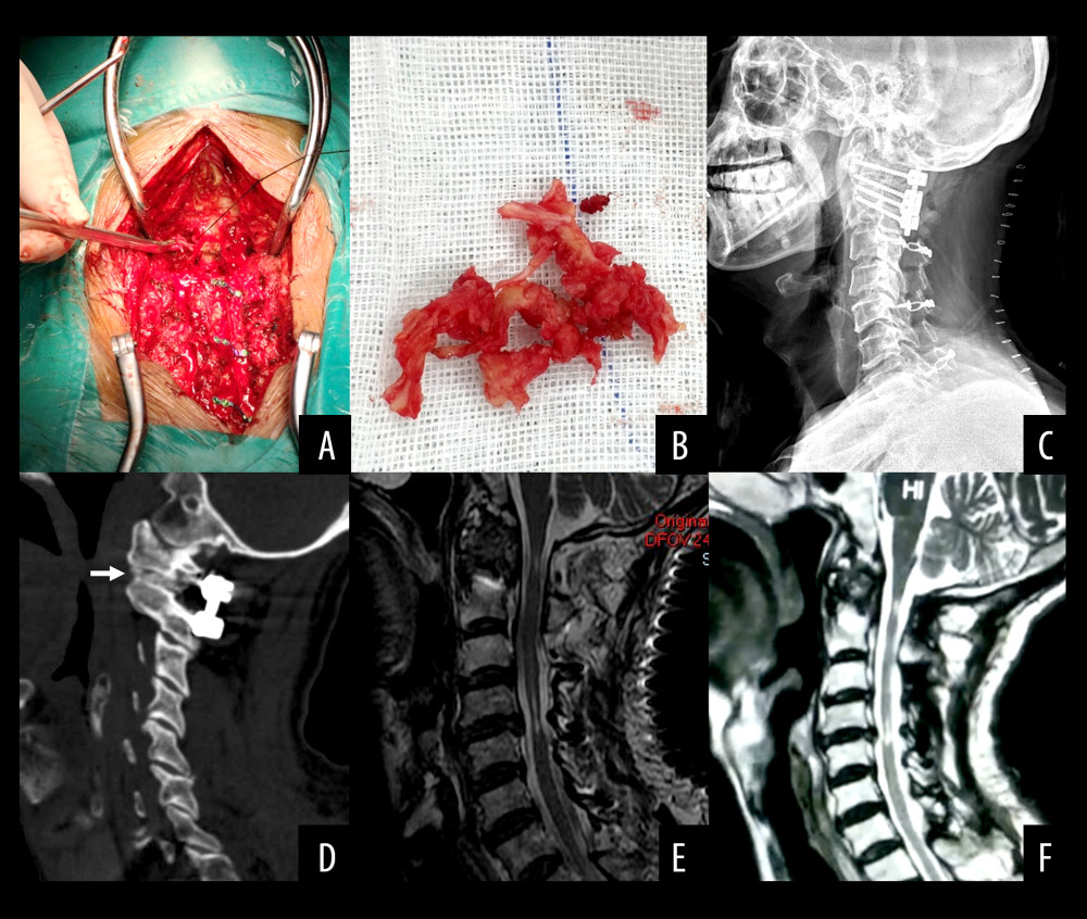 (A, B) The mass was resected via the lateral side of the spinal cord using a curette and clamp. The removed mass was composed of cartilaginous tissue. (C) Postoperative X-ray shows C1 lateral mass screw, C2 pedicle screw and rod fixation, and C3–C7 laminoplasty with centerpiece fixation. (D) Postoperative sagittal reconstructive computed tomography scan shows the bone graft in the lateral atlantoaxial joint. (E) Postoperative T2-weighted magnetic resonance imaging (MRI) shows complete resection of the pseudotumor and no compression of the spinal cord. (F) No tumor recurrence is shown at 1-year follow-up T2-weighted MRI.
