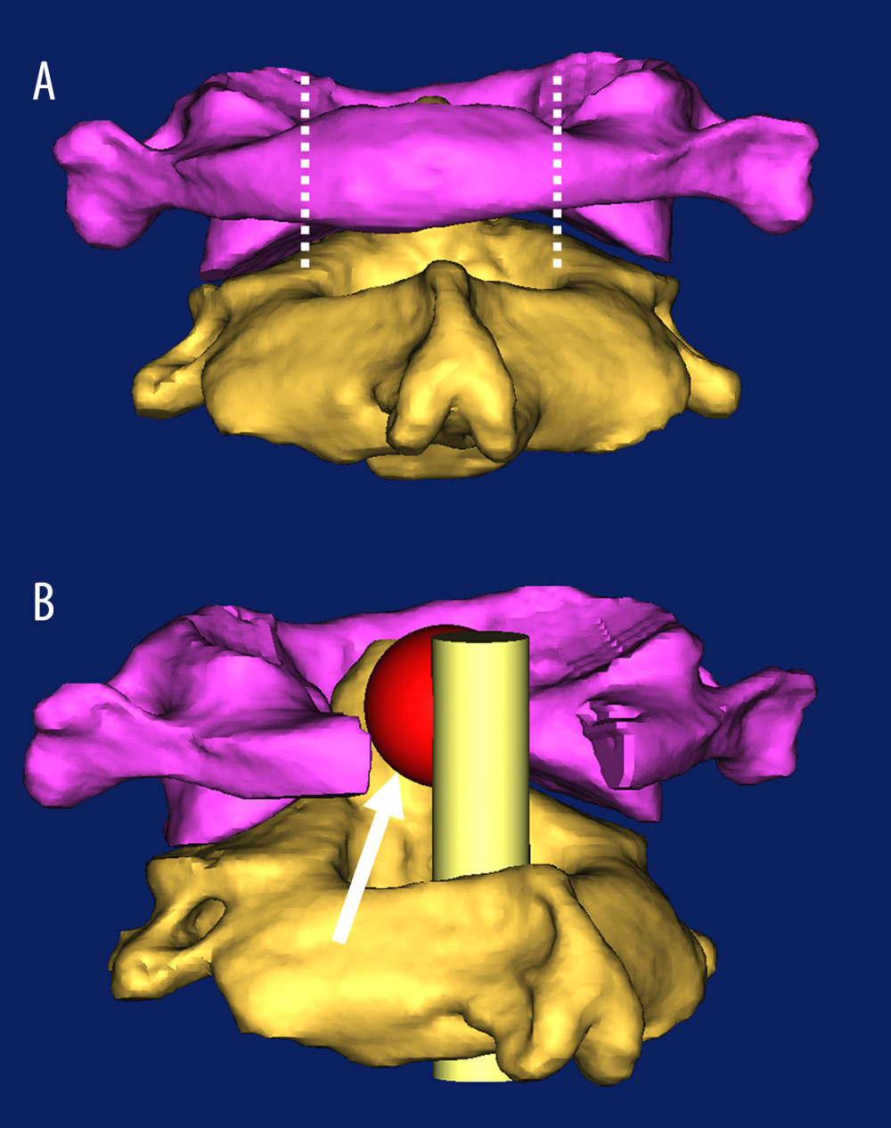 Schematic diagram for removal of the mass behind the dens. (A) The posterior view of the atlas and axis. The purple bone is the atlas, and the yellow bone is the axis. The area between the 2 white dotted lines represents the scope of the atlas laminectomy. (B) An oblique view of the atlas and axis after atlas laminectomy. The red sphere represents the retro-odontoid pseudotumor, the yellow cylinder represents the spinal cord, and the white arrow indicates the operative pathway.