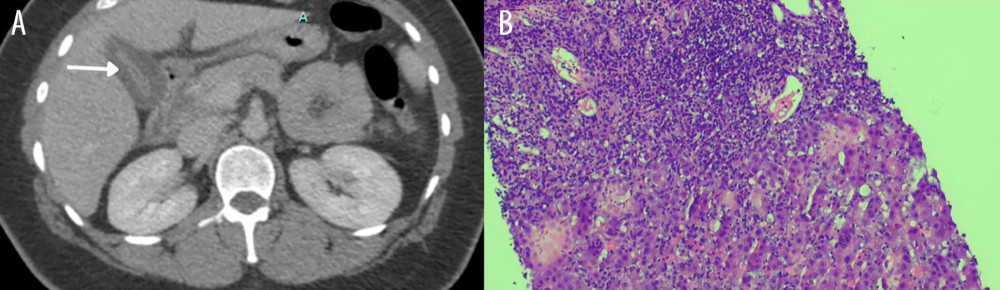 (A) Abdominal CT scan. The image shows marked mucosal thickening of the gallbladder and is indicated by the white arrow. (B) Histopathology of the liver showing autoimmune hepatitis. The sample is a core-needle biopsy of the right liver lobe. Hepatic architecture shows centrilobular-portal bridging necrosis and pronounced portal and lobular mixed inflammation with prominent plasma cells. The parenchyma shows marked lobular disarray with regeneration.