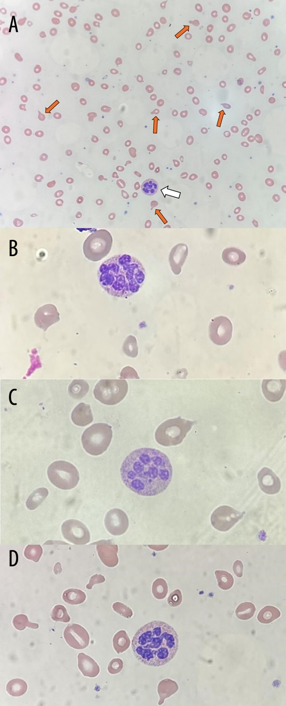 (A) Wright-Giemsa stain of the peripheral blood smear (×40) on admission showing a hypersegmented neutrophil (white arrow), poikilocytosis, anisocytosis, hypochromia, and teardrop cells (red arrows). (B) A neutrophil with 8–10 nuclear lobes. (C) A 7-lobed neutrophil. (D) A 6-lobed neutrophil.