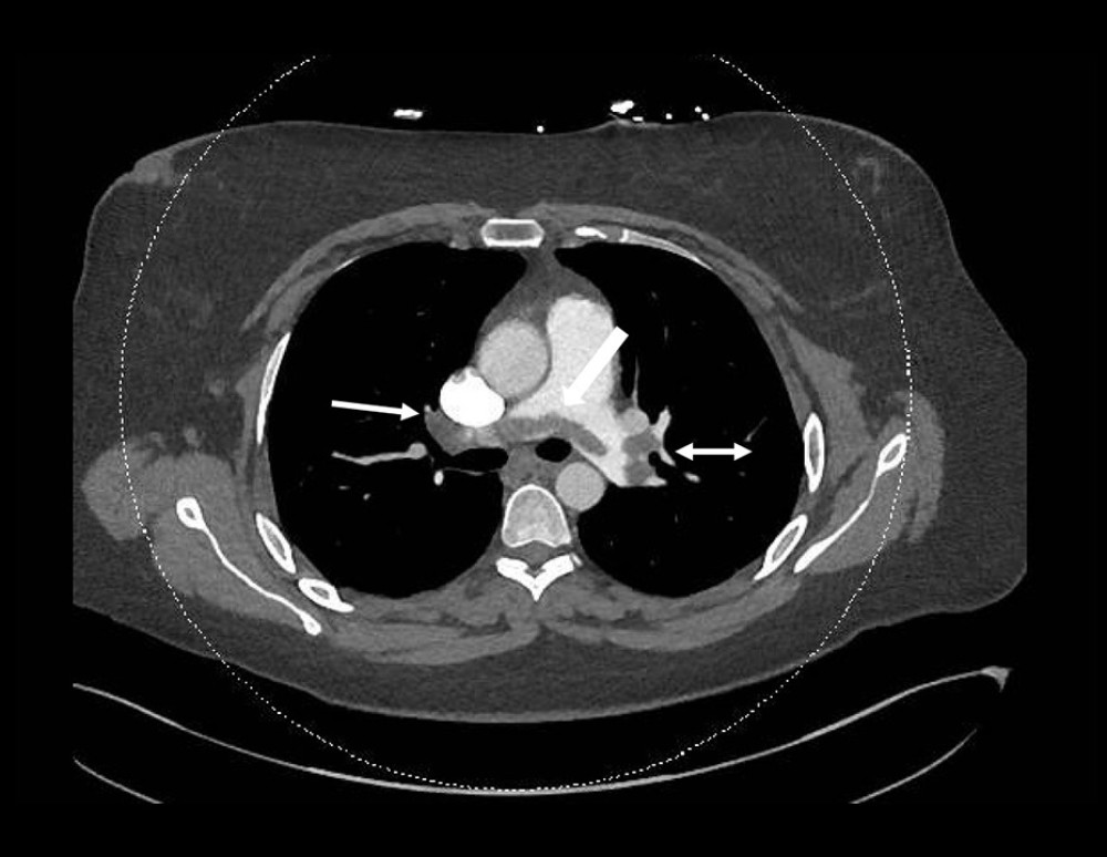 Computed tomography pulmonary angiography demonstrating a saddle embolus (block arrow) with extension into bilateral pulmonary branches. The right pulmonary artery clot is indicated by a single arrow, and a double arrow marks the clot in the left pulmonary artery.