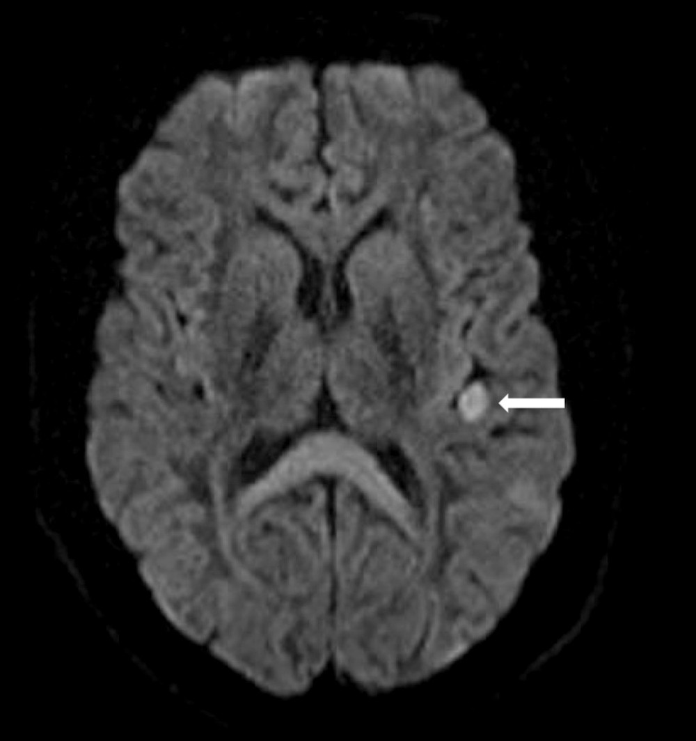 Magnetic resonance imaging of the brain demonstrating a small infarct in the left insular cortex (solid arrow).