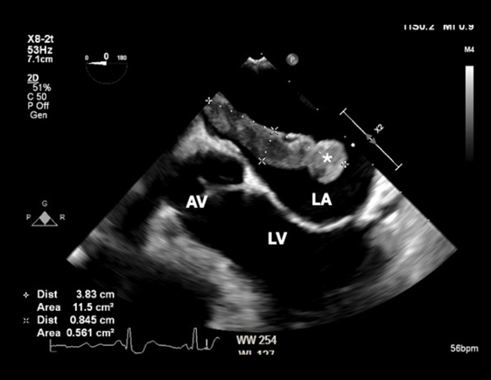 Intraoperative transoesophageal echocardiogram showing a large thrombus (*) within the left atrium, prolapsing toward the mitral valve. The aortic valve (AV), left atrium (LA), and left ventricle (LV) are labeled for anatomical orientation.