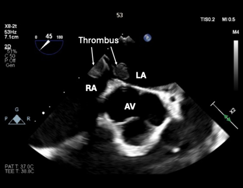Intraoperative transoesophageal echocardiogram showing visible portions of thrombus (arrows) in both the left atrium and right atrium. Left atrium (LA), right atrium (RA), and aortic valve (AV) are labeled for anatomical orientation.