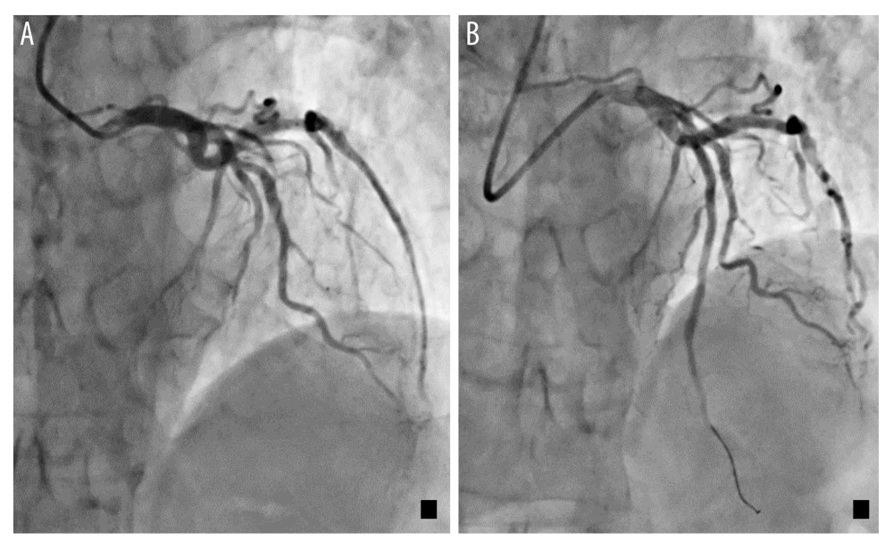 Coronary angiogram images showing (A) left anterior descending artery (LAD) occlusion; (B) LAD reperfusion after angioplasty and stent insertion.
