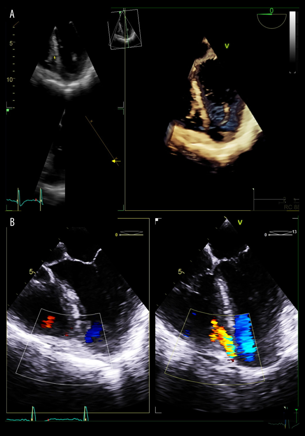 Preprocedural transesophageal echocardiogram with apical 4-chamber window. (A) 3D image of a ventricular septal defect (VSD) is shown at the junction of the septum and an apical ventricular aneurism measuring 10 mm. (B) Color Doppler of the VSD shows a left-to-right shunt.