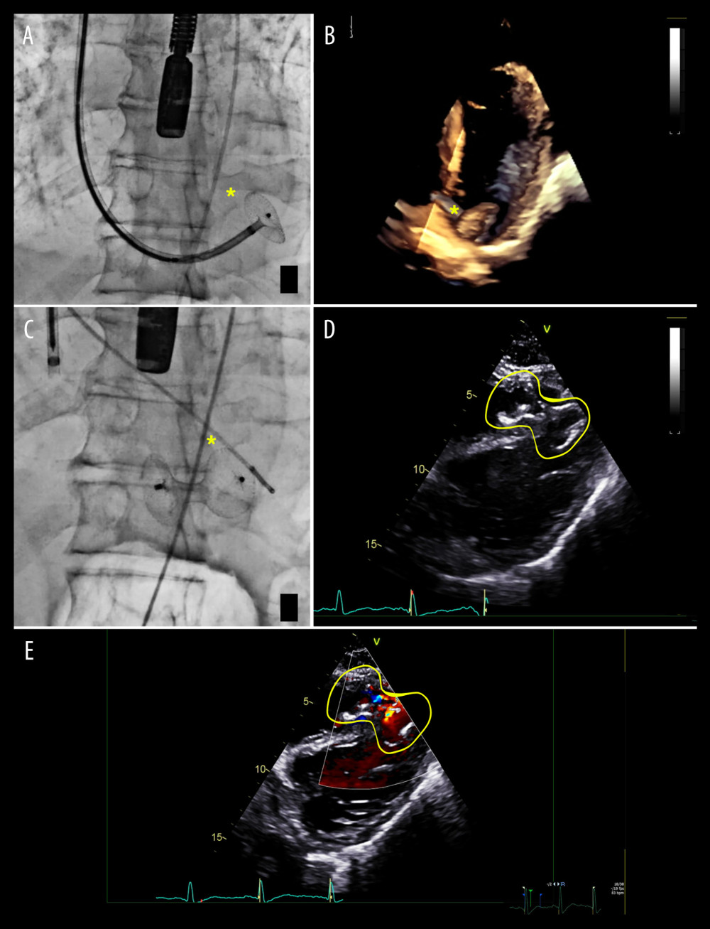 Fluoroscopic and transesophageal echocardiogram (TEE) guidance images showing (*) (yellow) septal defect closure device; (A, B) opening of the left disc on fluoroscopy (A) and 3D TEE (B); (C, D) properly positioned septal occluder on fluoroscopy (C) and TEE (D); and (E) TEE Doppler imaging: residual left-to-right shunt.
