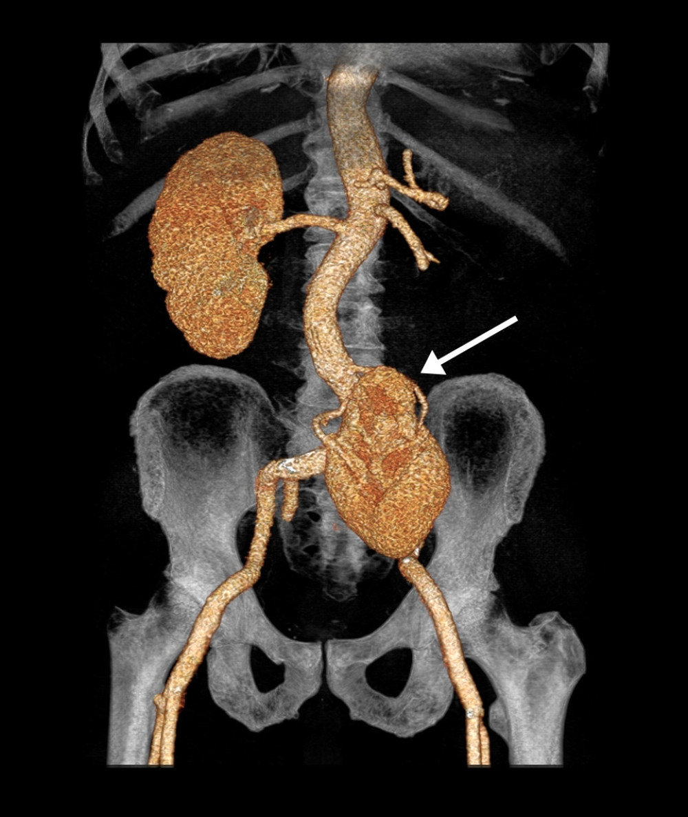 Three-dimensional reconstruction of the abdominal-pelvic region demonstrating pelvic ectopic kidney. The pelvic kidney is indicated by the white arrow.