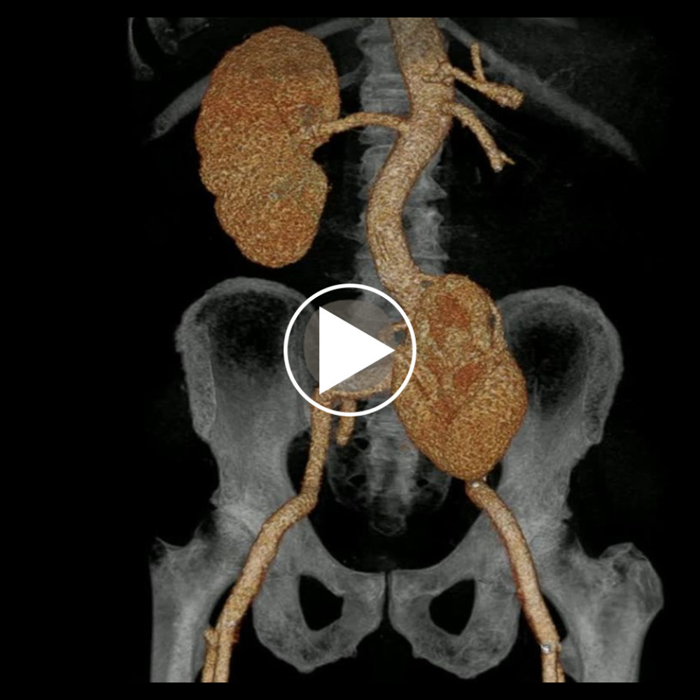 Rotational video of three-dimensional CT reconstruction of the abdominal-pelvic region demonstrating pelvic ectopic kidney. The video displays the spatial and anatomic relationships of the ectopic kidney within the pelvic cavity.