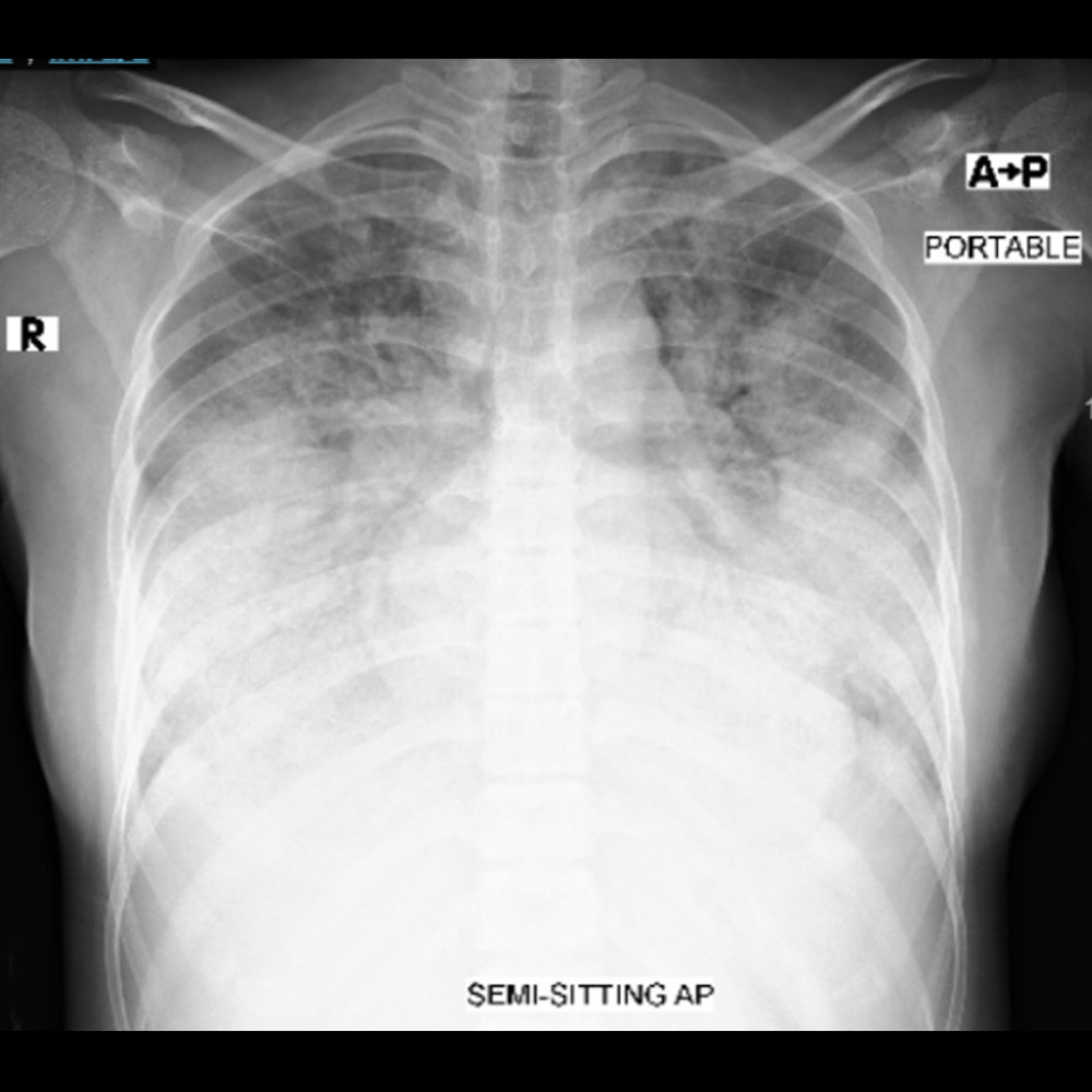 Chest X-ray. Anterior-posterior (AP) projection revealed bilateral diffuse airspace opacity.