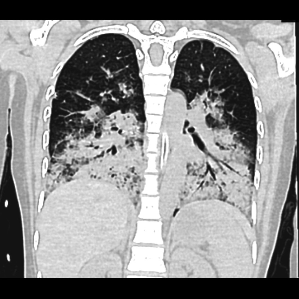 High-resolution computed tomography showing severe pulmonary consolidations.
