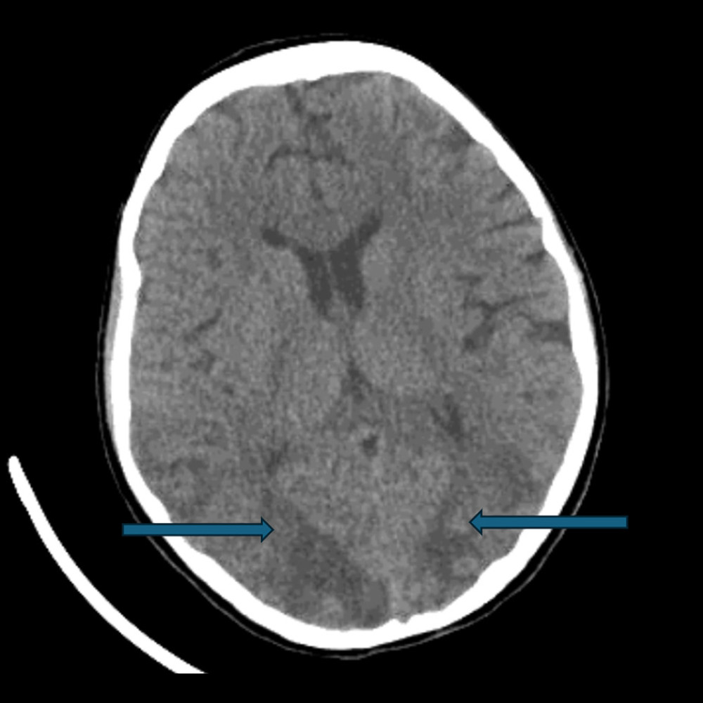 Computed tomography of the brain without contrast demonstrating bilateral occipital ill-defined white matter hypodensities consistent with vasogenic edema (arrows).