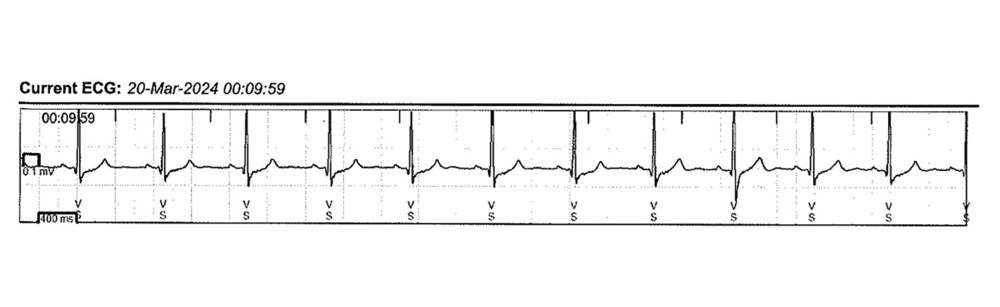 Baseline electrocardiogramThe patient’s baseline electrocardiogram from the implanted loop recorder.