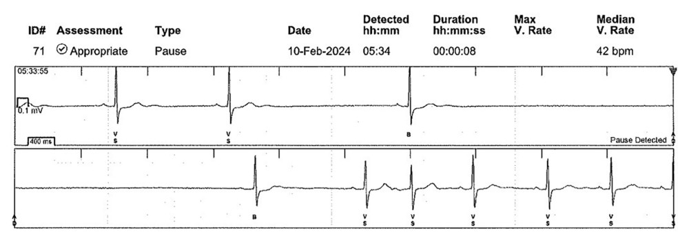 Eight-second asystoleThe electrocardiogram from the patient’s implanted loop recorder demonstrates an approximately 8-second asystole during his usual sleeping hours. This event occurred during the self-titration phase of hypoglossal nerve stimulation therapy, while off bilevel positive airway pressure therapy. The vertical lines at the top of each row denote 1-second intervals.