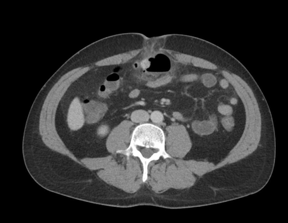 CT scan showing umbilical hernia with coprolith and ischemic signsAxial contrast-enhanced CT scan showing an umbilical hernia containing small-bowel loops and a rounded structure consistent with a coprolith (fecalith). Surrounding fat stranding indicates inflammatory changes and early signs of ischemia.