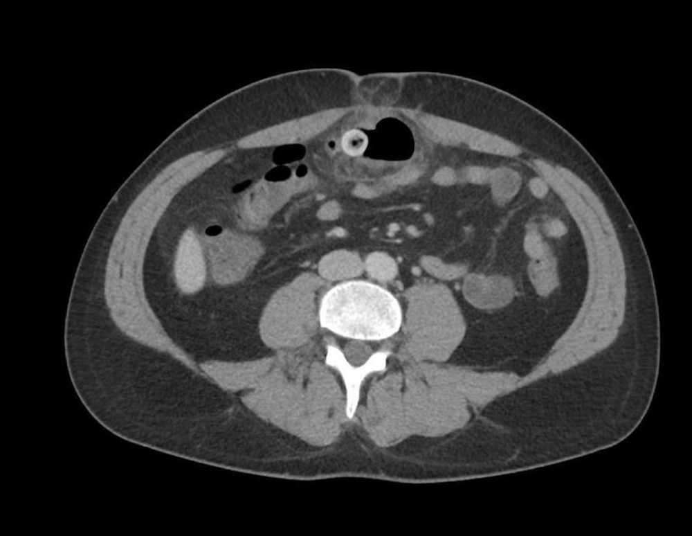 CT scan showing progression of herniated content and inflammationAxial CT scan at a slightly cranial level showing progression of herniated pre-peritoneal content with surrounding fat stranding and air inclusions. The abdominal wall defect and location of the incarcerated segment are clearly visible.