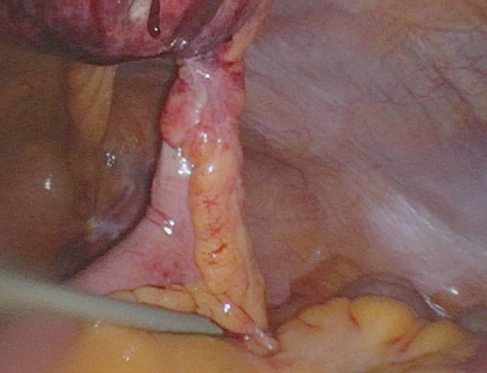 Laparoscopic view of incarcerated Meckel’s diverticulumIntraoperative laparoscopic view showing the incarcerated and ischemic Meckel’s diverticulum protruding into the umbilical hernia sac. The antimesenteric location and inflammatory reaction of the surrounding tissue are visible.