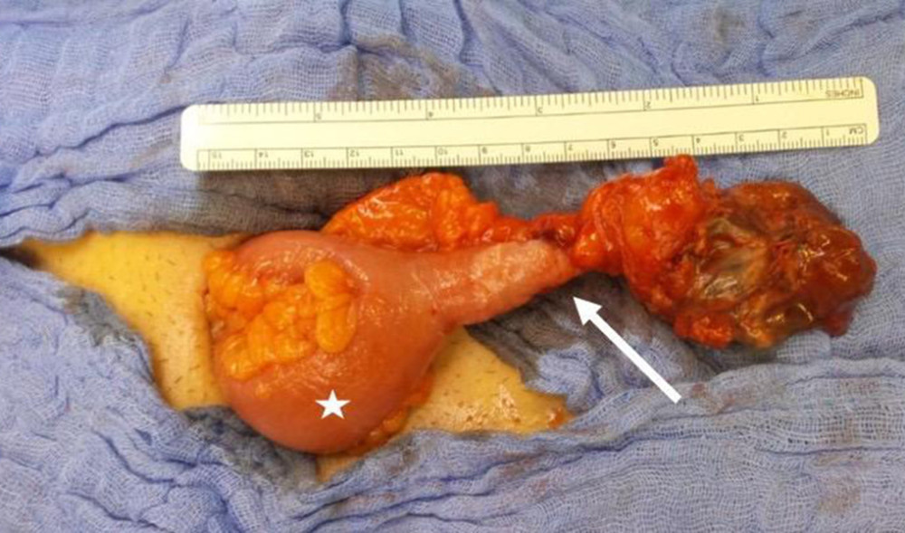 Resected specimen showing Meckel’s diverticulum with necrosis and coprolithIntraoperative image following mini-laparotomy. The star marks the viable ileum, and the arrow points to the resected Meckel’s diverticulum with signs of necrosis and perforation. A large coprolith is visible within the diverticulum tip.