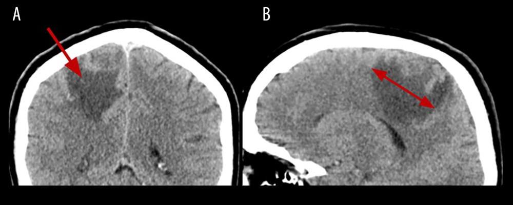 The head native CT with reconstructions in the coronal plane (A) and sagittal plane (B) zoomed in. In the right hemisphere of the brain an irregularly shaped lesion around 2.8 cm. Areas of heterogeneous hypodense edema around the lesion.