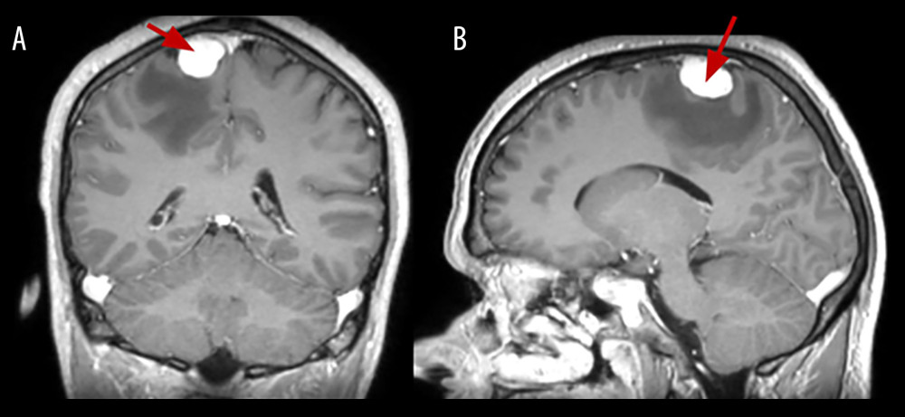 The brain MRI sequence T1 after contrast injection in the coronal plane (A) and sagittal plane (B). On the convex surface of the parietal lobe of the right hemisphere is about 2.5×1.6 cm homogeneous lesion. Accumulation of the contrast is consistent and intensive.