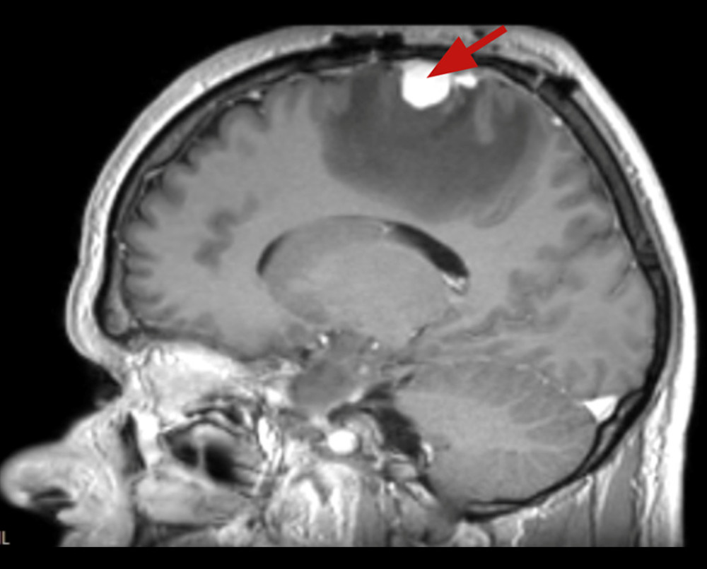 The brain MRI 6 months after the surgery sequence T1 in the sagittal plane with contrast injection. In the right parietal lobe, at the site of excision, an irregularly shaped lesion 2.4×2.0×1.4 cm in antero-posterior×latero-lateral×cranio-caudal directions. Tissues of the lesion steadily and intensely accumulated contrast.