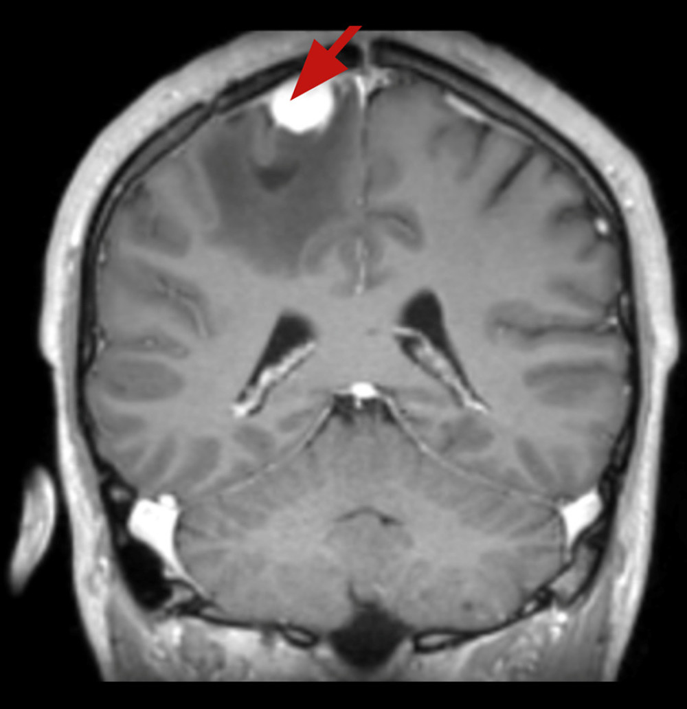 The brain MRI 6 months after the surgery sequence T1 in the coronal plane with contrast injection. Recurrence of a convexity tumor above the right parietal lobe: atypical meningioma is suspected