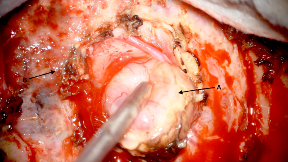Surgical area in right temporal region, resection of a recurrent tumor (A), dura mater of the brain (B).