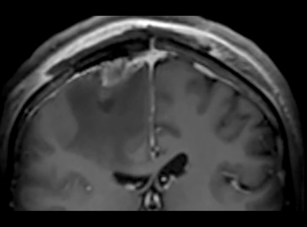 An MRI of the head sequence T1 in the coronal plane following osteoplastic recraniotomy and removal of the tumor, zoomed in. Blood products were observed in the surgical site, with no signs of remaining tumor tissue. Extensive perifocal edema was noted.