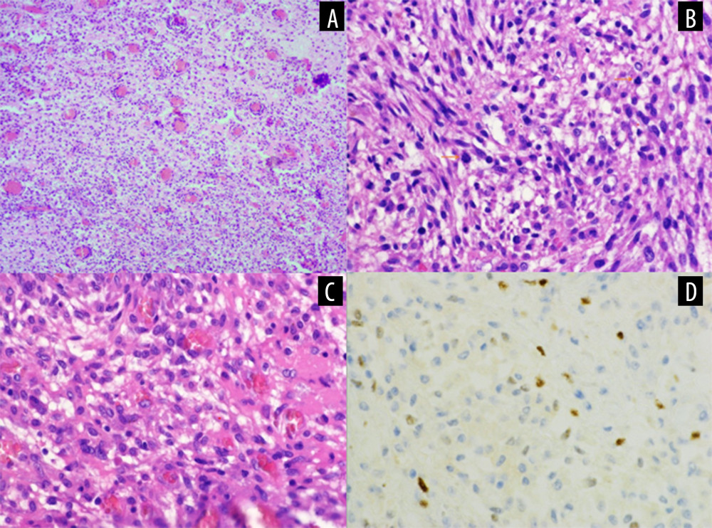 Atypical angiomatous meningioma (CNS WHO grade 2), with notably increased cellularity, original magnification (OM) 100× (A). Atypical angiomatous meningioma (WHO grade 2), note presence of mitotic figures (arrows) and increased tumor cellularity, OM 400× (B). Atypical angiomatous meningioma (WHO grade 2), note spindle shaped tumor cells, with overall increased tumor cellularity, and vascular network, OM 400× (C). Progesterone expression in atypical angiomatous meningioma (WHO grade 2), OM 400× (D).