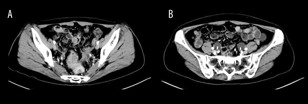 Magnetic resonance imaging of the lower abdomen showing several masses in the abdomen and pelvis.