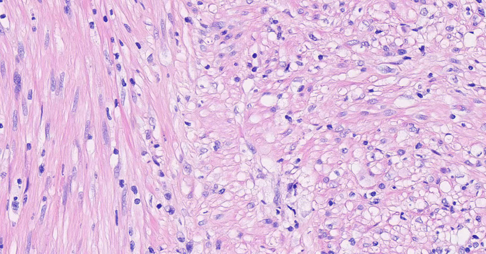 A photomicrograph of the histopathology of a peritoneal nodule in a 59-year-old woman presenting with disseminated peritoneal leiomyomatosis. Image shows well-differentiated smooth muscle cells in a cross-bundle, woven arrangement with long, bluntly rounded nuclei, no obvious cellular anisotropy, no or few nuclear schizophrenic images, and no necrosis, interstitial fibrosis, or vitreous degeneration. Hematoxylin and eosin staining, magnification ×60.