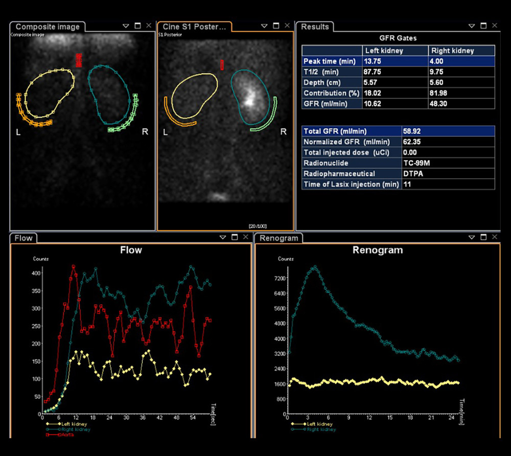 99mTc-DTPA renal dynamic imaging results showing the split renal function of the patient’s kidneys.