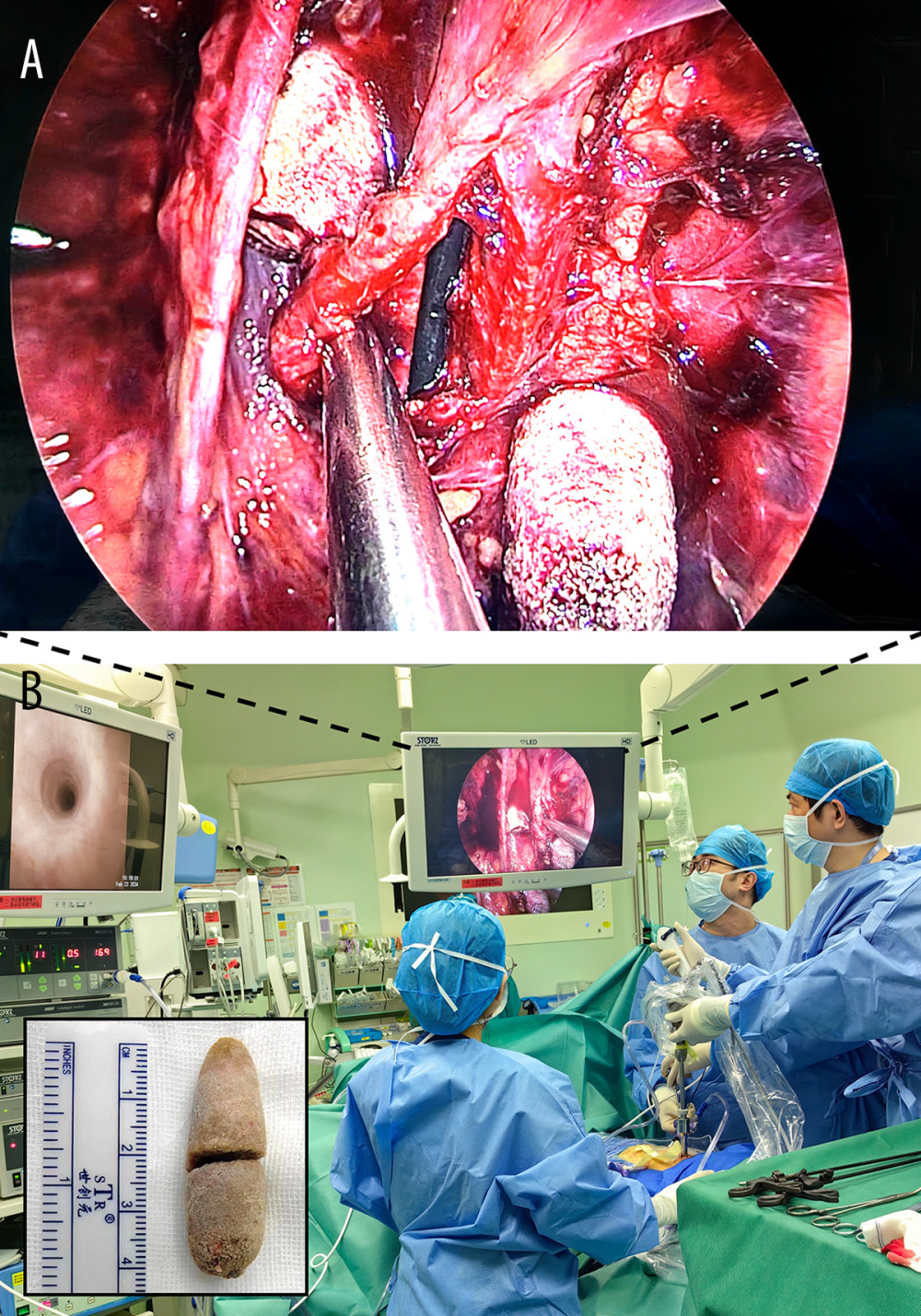 The operative setup showing the flexible ureteroscopy screen (B) and laparoscopic image (A) when the large ureteral stone is identified. The extracted bullet-shaped stone (square) measured 4.2×1.5×1.5 cm but split in half intraoperatively.