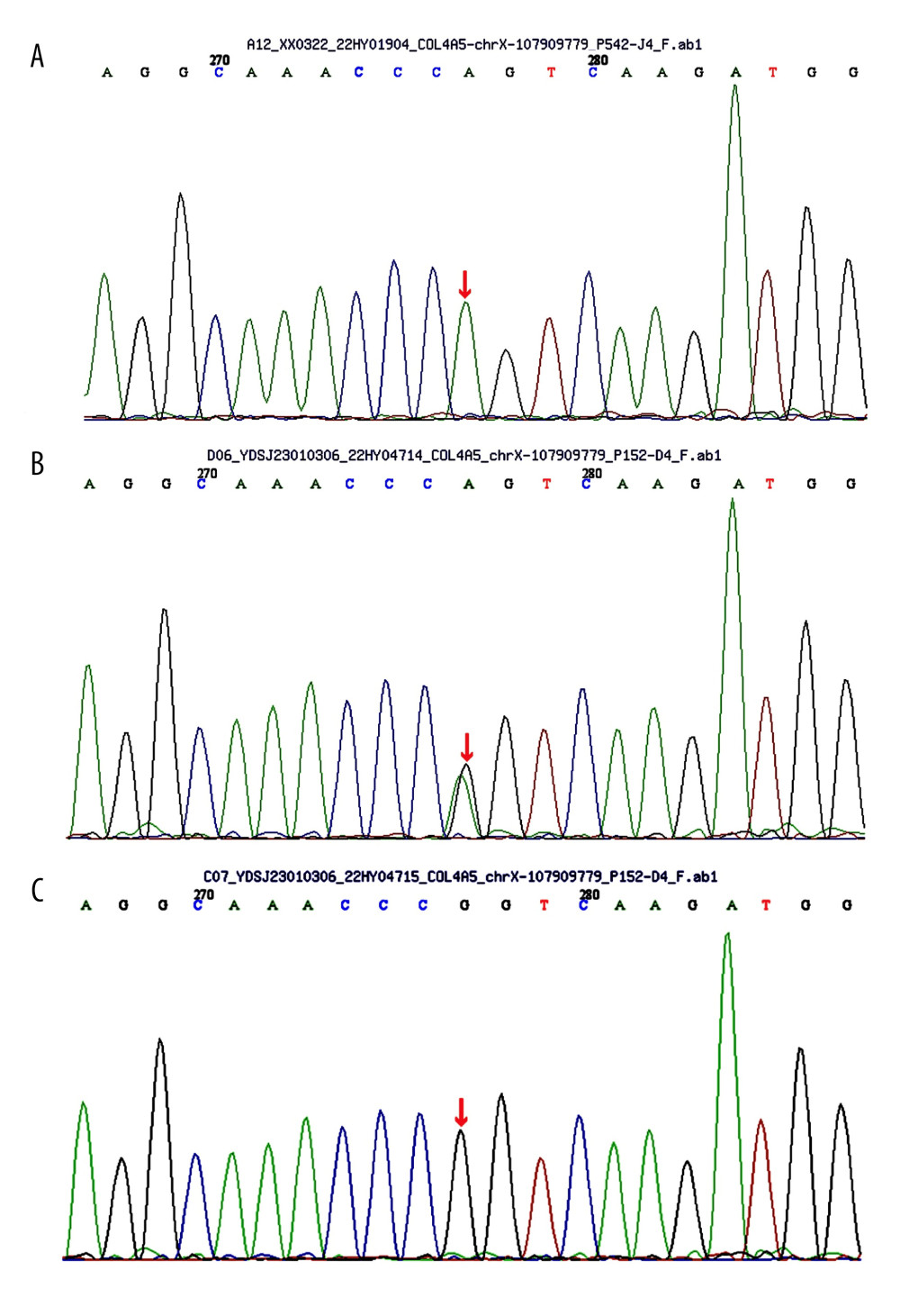 (A) Sequence of the heterozygous COL4A5 c.3508G>A p.G1170S del variant (II-1). (B) Sequence of the heterozygous COL4A5 c.3508G>A p.G1170S del variant (II-2). (C) Sequence of unaffected individuals (I-2).