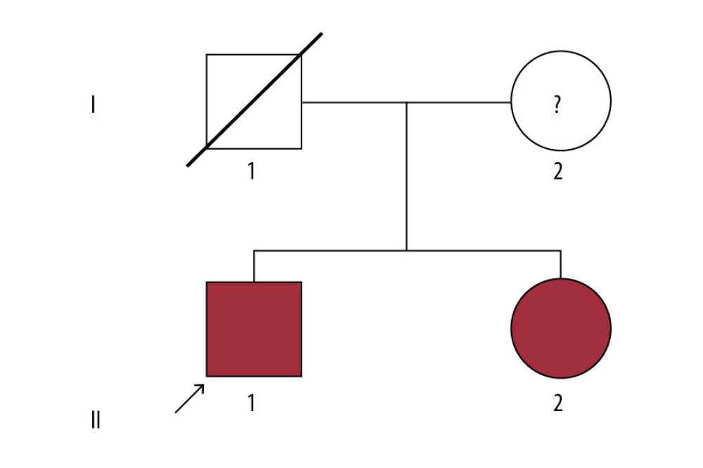 Pedigree of the Alport syndrome family. The red filled symbols represent patients carrying the COL4A5 c.3508G>A p.G1170S missense variant. The proband is marked with a black arrow.
