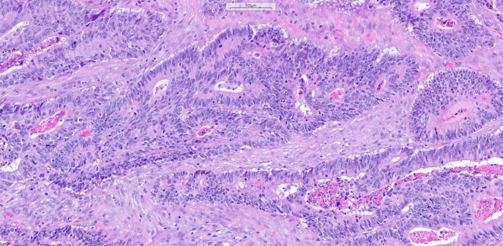Histopathological picture of adenocarcinoma dated 30.09.2021.