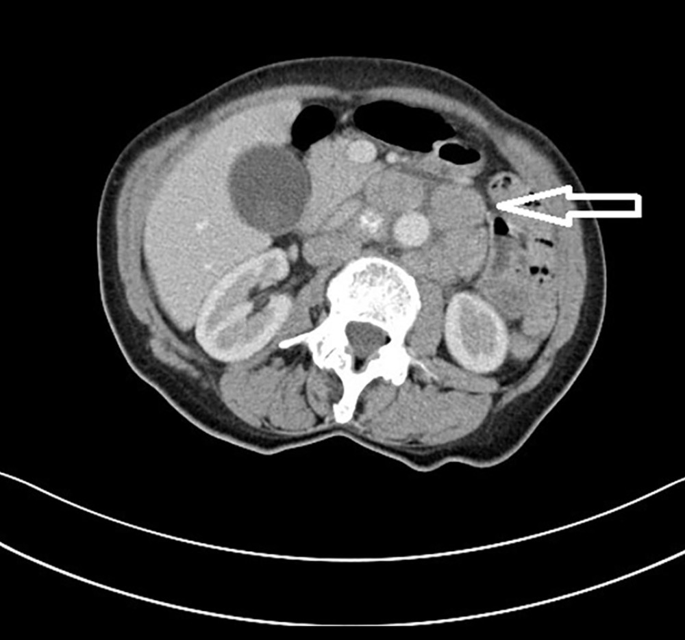 CT scan of the abdomen dated 01.10.2021 (enlarged periaortic lymph nodes with a dimension of 23 mm are marked with an arrow).