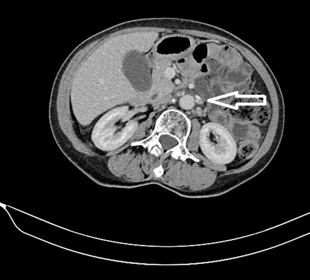 CT scan of the abdomen dated 01.07.2022 (periaortic lymph nodes with a dimension of 6 mm are marked with an arrow; complete remission was assessed according to RECIST 1.1).