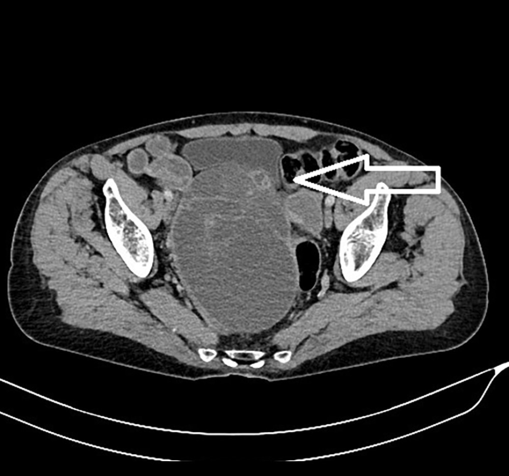 CT scan of the pelvis dated 22.08.2023 (arrow marks the tumor lesion in the pelvis).